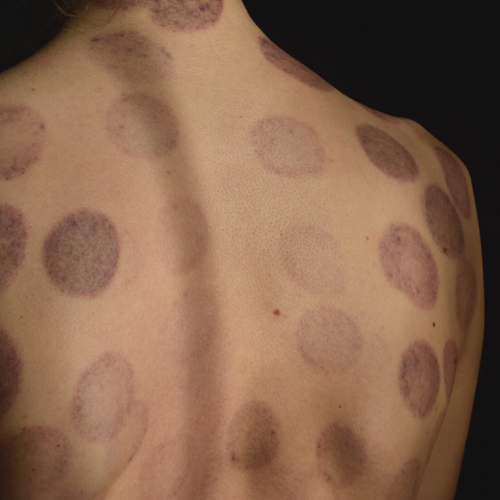 Close-up of cupping marks on a person's back after treatment